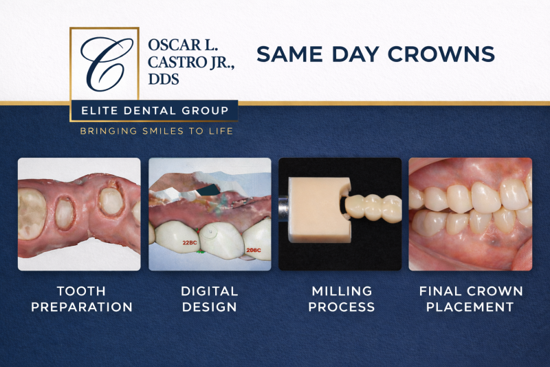 Infographic showing the 4-step process of Same Day Crowns: preparation, digital design, milling, and final placement